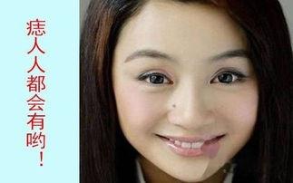 脸上长黑点的明星